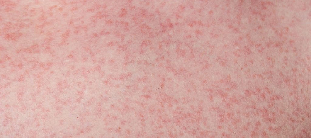 dengue rashes